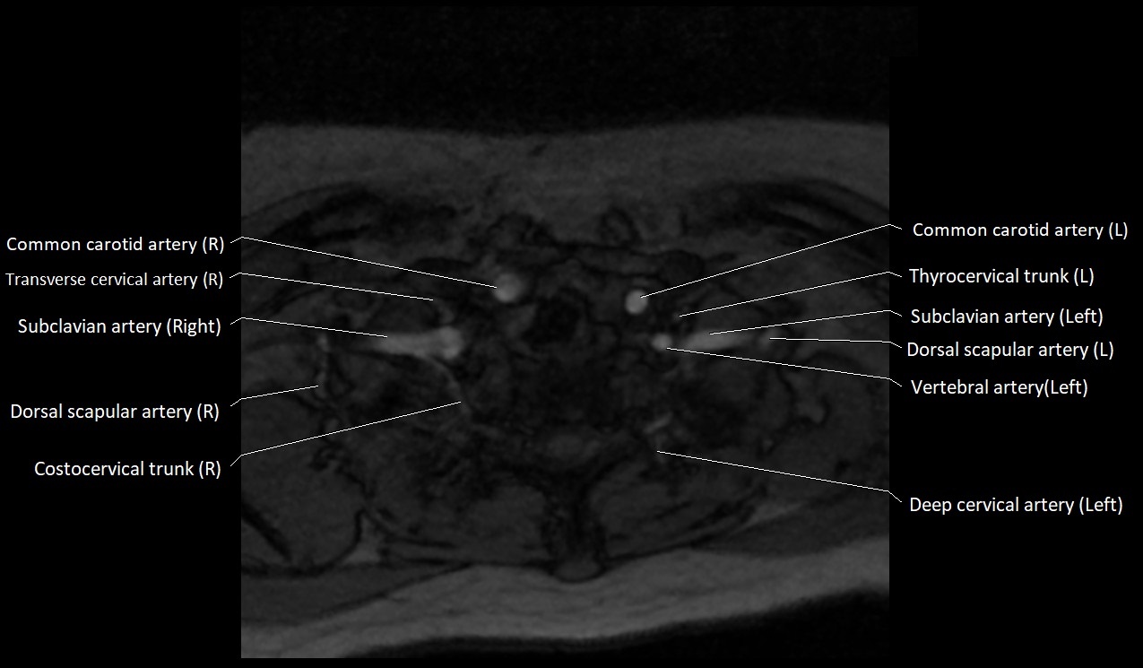 Carotid artery anatomy axial 3T image 67.jpg
